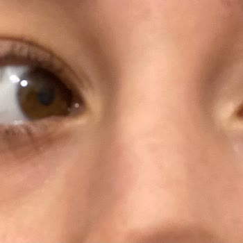 Alerji Yapan Güneş Kremi Mağduriyeti