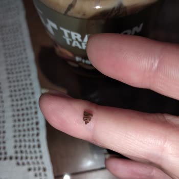 Fıstık Ezmesi Yüzünden Dişim Kırıldı Ve Büyük Risk Taşıyor