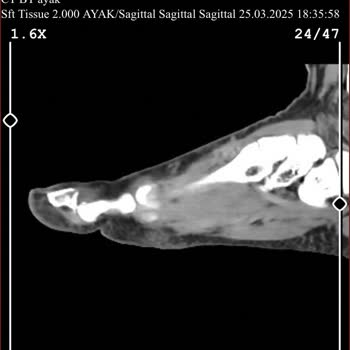 Yanlış Tedavi Yüzünden Hayatım Kısıtlandı
