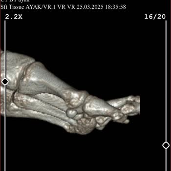Yanlış Tedavi Yüzünden Hayatım Kısıtlandı