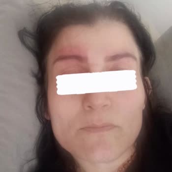 Kaş Kirpik Serumu Sağlık Sorunlarına Yol Açtı