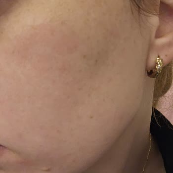 La Roche - Posay Krem Alerji Yaptı, Para İadesi Yapılmıyor