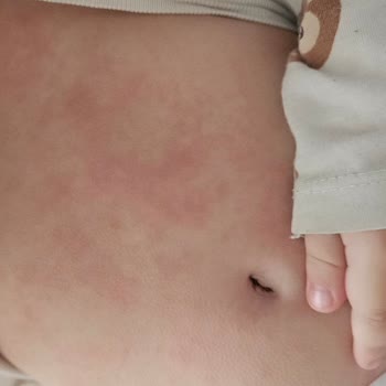 La Roche - Posay Krem Alerji Yaptı, Para İadesi Yapılmıyor