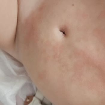 La Roche - Posay Krem Alerji Yaptı, Para İadesi Yapılmıyor