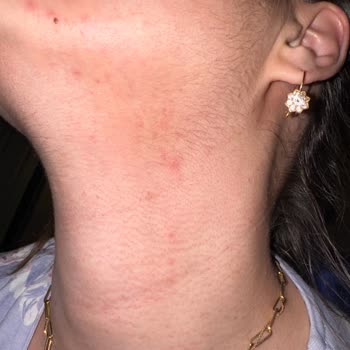 Alerjik Reaksiyon: Yves Rocher Ürünlerinden Beklenmedik Sorun