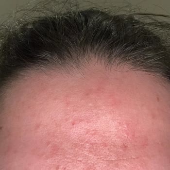 Alerjik Reaksiyon: Yves Rocher Ürünlerinden Beklenmedik Sorun