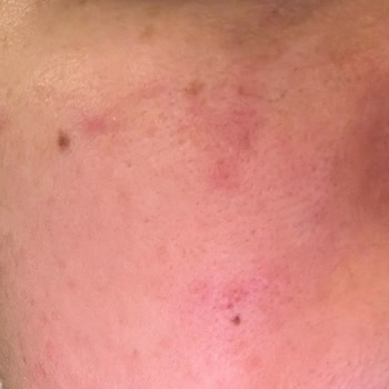 Alerjik Reaksiyon: Yves Rocher Ürünlerinden Beklenmedik Sorun