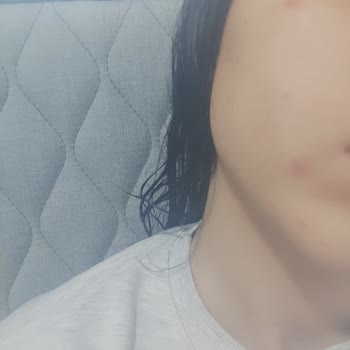 Ciltte Sivilce Yapan Pudra Sorunu