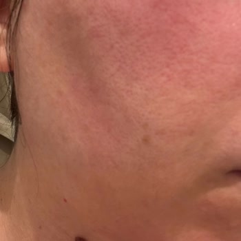 Kolonya Kullanımı Sonrası Ciltte Yanma Şikayeti