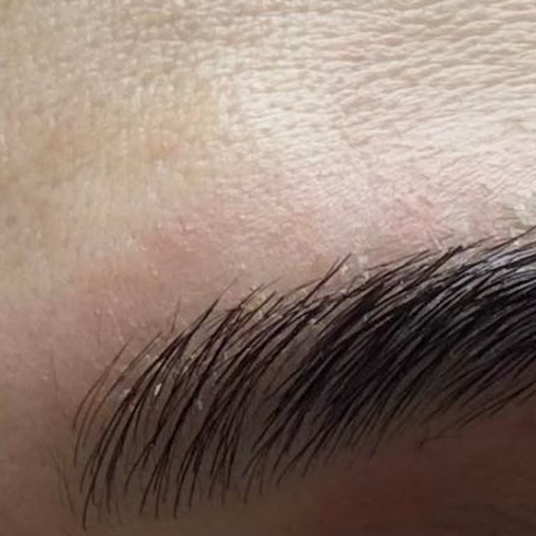 Note Kaş Vakası: Alerjik Reaksiyon Ve Kaş Dökülmesi Sorunu