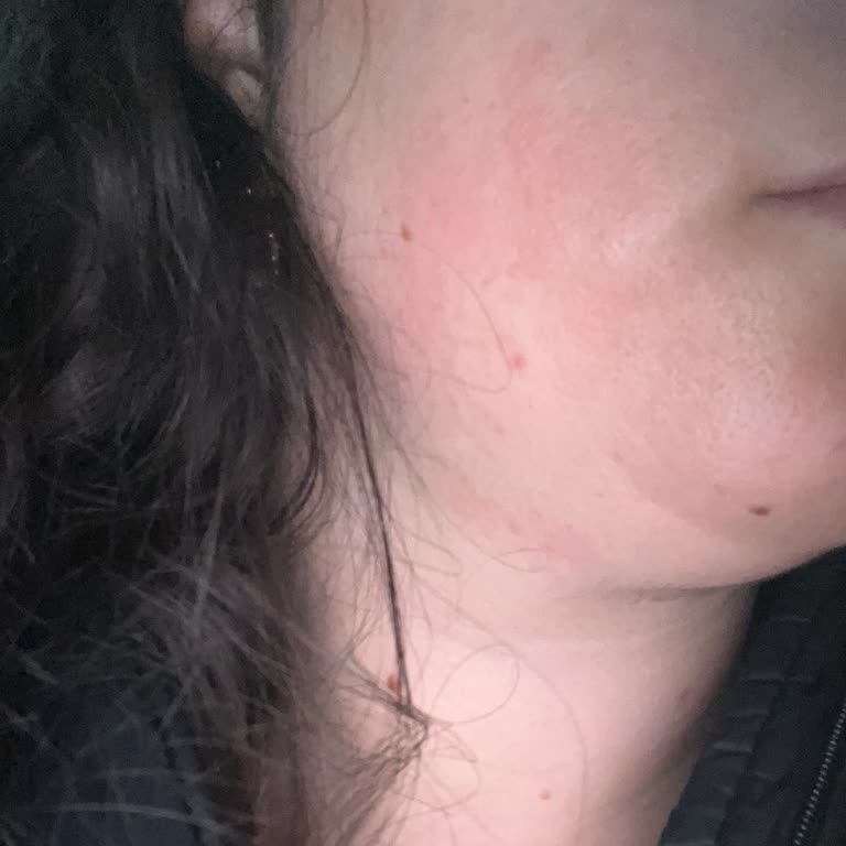 Retinol Gece Serumu Yüzümde Yanık Oluşturdu