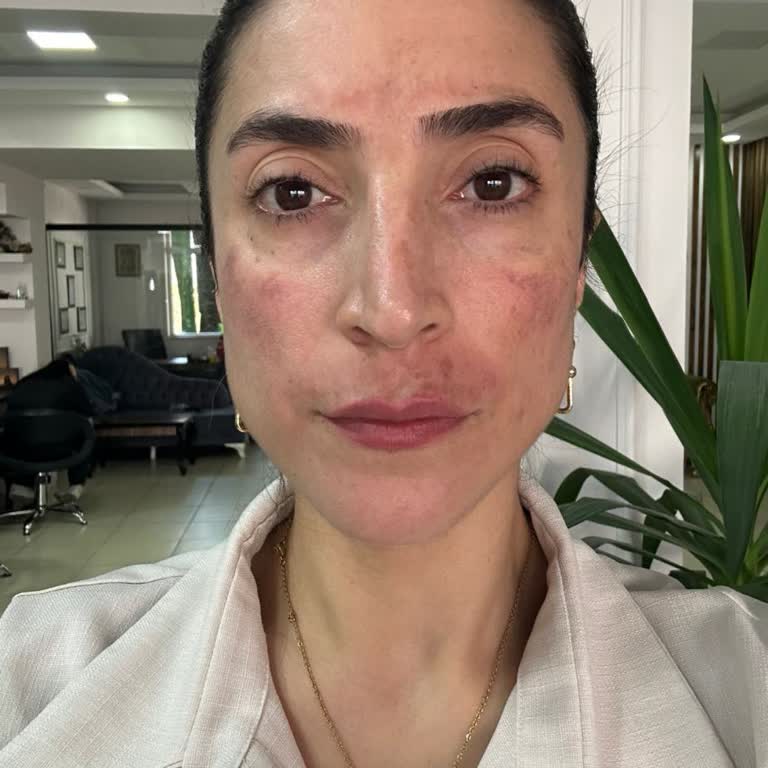 Dermapen İşlemi Sonrası Kalıcı İzler Ve Mağduriyet