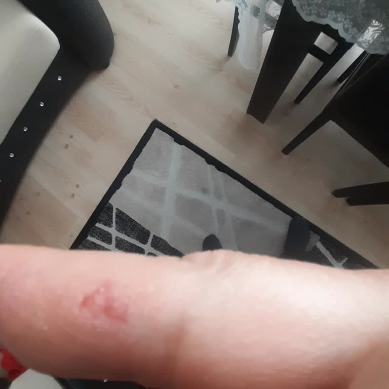 I Struggled to Open Novartis Zaditen Syrup—Cap Design Caused Pain and Injury