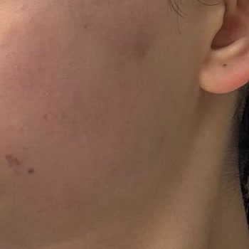 Sesu Tüy Sarartıcı Krem Yüzde Renk Değişikliğine Sebep Oldu