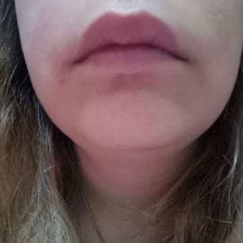 Yanlış Teşhis Ve İlgisizlik Sebebiyle Ciddi Sağlık Sorunları Yaşadım