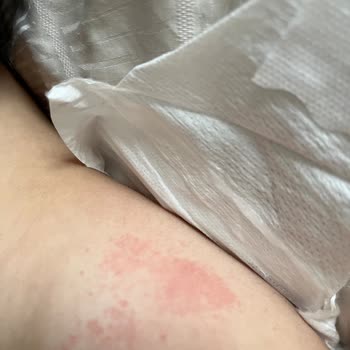 Molfix Bezlerinde Kalite Düşüşü Ve Pişik Sorunu