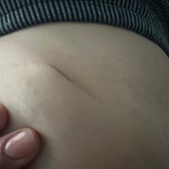 Karın Germe Ameliyatı Sonrası Sorunlar