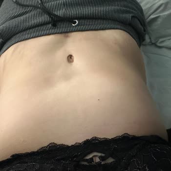 Karın Germe Ameliyatı Sonrası Sorunlar