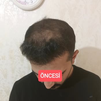 Anatolia Haar Implantat hat schlechte Ergebnisse und Haarausfall nach Behandlung