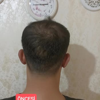 Anatolia Haar Implantat hat schlechte Ergebnisse und Haarausfall nach Behandlung