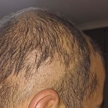 Anatolia Haar Implantat hat schlechte Ergebnisse und Haarausfall nach Behandlung