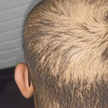 Anatolia Haar Implantat hat schlechte Ergebnisse und Haarausfall nach Behandlung