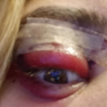 Başarısız Göz Kapağı Ameliyatı Ve İlgisiz Hizmet