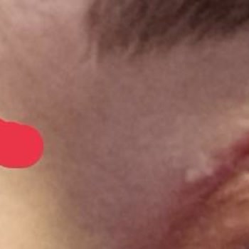 Başarısız Göz Kapağı Ameliyatı Ve İlgisiz Hizmet