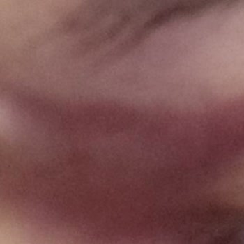 Başarısız Göz Kapağı Ameliyatı Ve İlgisiz Hizmet