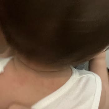 Goon подгузники вызывают аллергию у ребёнка
