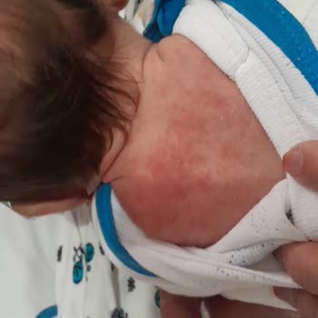 Шампунь Johnsons Baby для младенцев вызвал аллергию