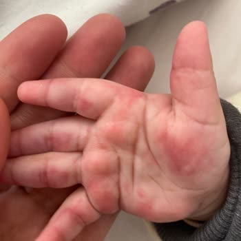 Bebek Kan Alımı Sırasında Yaşanan Sorun