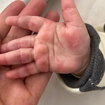 Bebek Kan Alımı Sırasında Yaşanan Sorun