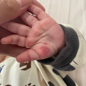 Bebek Kan Alımı Sırasında Yaşanan Sorun