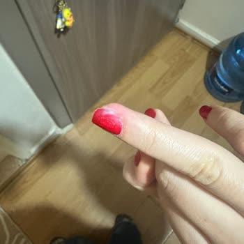 Sterilizasyon Eksikliği İle Sağlık Sorunu Yaşadım