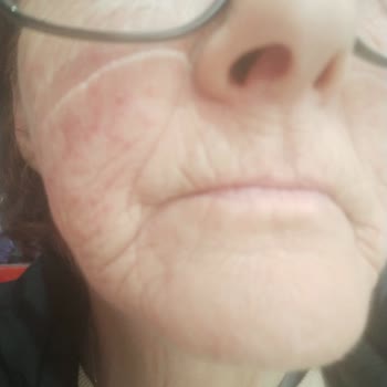 Nivea Jel Cildimde Alerji Yaptı