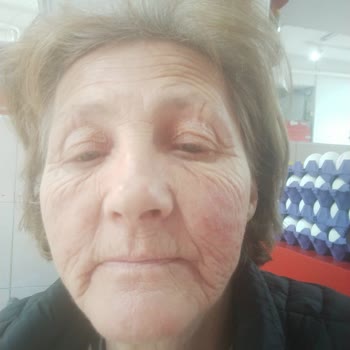 Nivea Jel Cildimde Alerji Yaptı