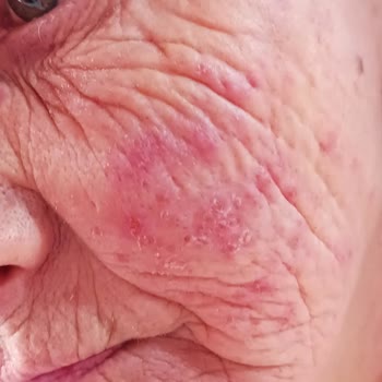 Nivea Jel Cildimde Alerji Yaptı