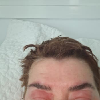 I Experienced Swelling and Irritation from Ducray Dexyane Med Palpebral Eye Cream