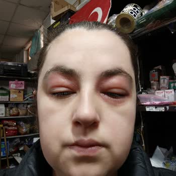 I Experienced Swelling and Irritation from Ducray Dexyane Med Palpebral Eye Cream