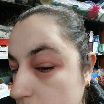 I Experienced Swelling and Irritation from Ducray Dexyane Med Palpebral Eye Cream