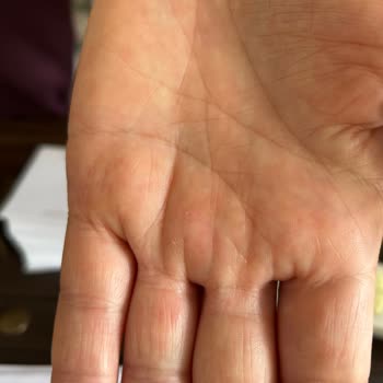 Desa Çantasıyla Gelen Sağlık Sorunu Ve İlgisizlik