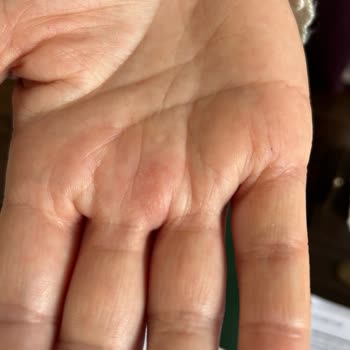 Desa Çantasıyla Gelen Sağlık Sorunu Ve İlgisizlik