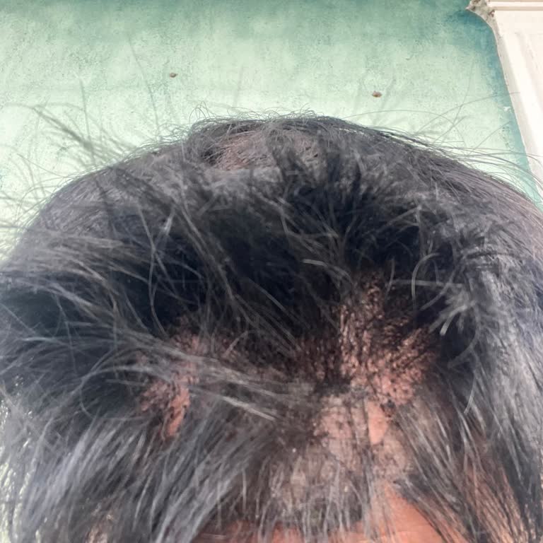 S Well Hair'de 1.5 Ayda Kullanılamaz Hale Gelen Protez Saç!