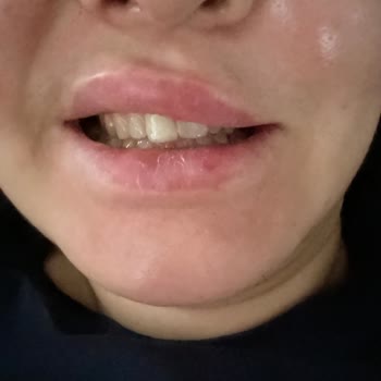 Estetik İşlem Sonrası Hayal Kırıklığı Ve Fatura Sorunu