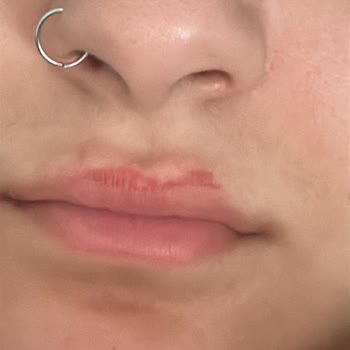 Sesu Yüz Ağda Bandı Sebebiyle Cilt Hasarı Ve Rahatsızlık!