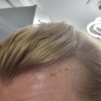 Saç Boyası İle Gelen Yanık Şoku