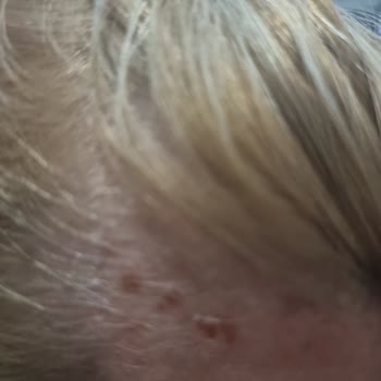 Saç Boyası İle Gelen Yanık Şoku