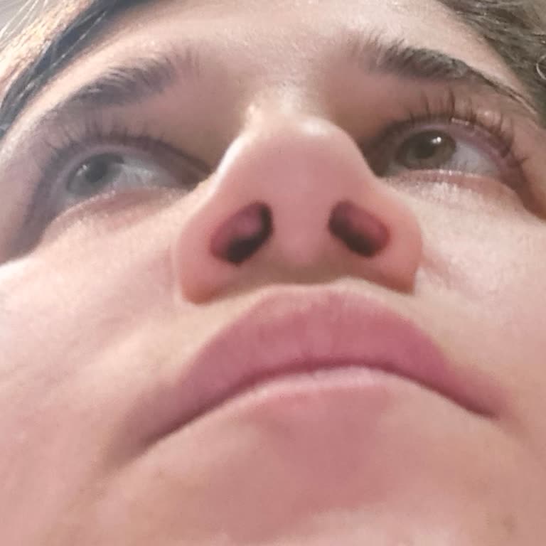 Başarısız Rinoplasti Ve İlgisiz Doktor