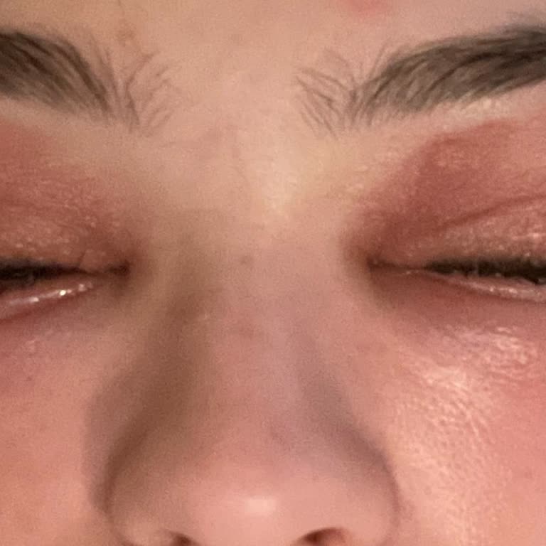 Kirpik Liftingi Sonrası Göz Sağlığı Sorunu